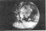 Pg 159 fundus photo